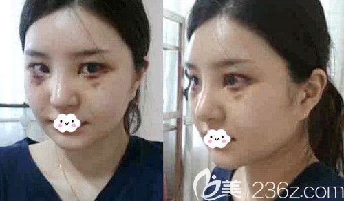 武漢卓美耳軟骨復(fù)合隆鼻術(shù)后7天恢復(fù)圖 武漢卓美耳軟骨復(fù)合隆鼻術(shù)后7天恢復(fù)圖