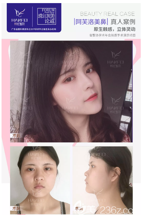 廣州韓妃沈紹勇鼻綜合隆鼻案例 廣州韓妃沈紹勇鼻綜合隆鼻案例