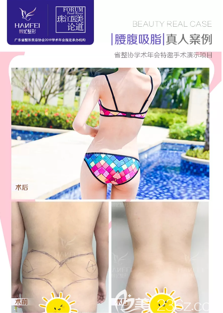 廣州韓妃于洪瑞腰腹部吸脂案例 廣州韓妃于洪瑞腰腹部吸脂案例