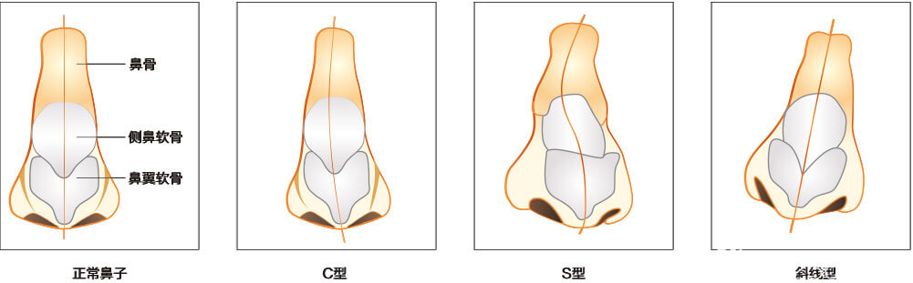 歪鼻的分類