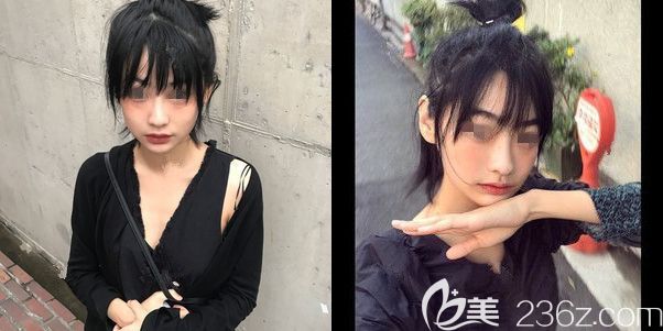 M唇術(shù)后一個(gè)月恢復(fù)