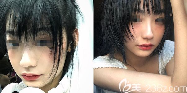 知道微笑唇可能留疤后選南京韓辰做了M唇，術(shù)后三個月麻木感才消失