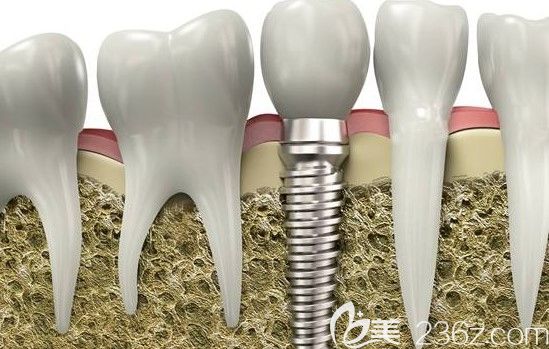 羅維明院長科普：種植牙的創(chuàng)口大嗎