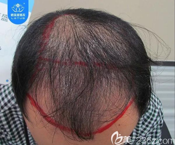 ?6級脫發(fā)植發(fā)4500單位，看看狂脫期后頭發(fā)會呈現(xiàn)怎樣的效果？