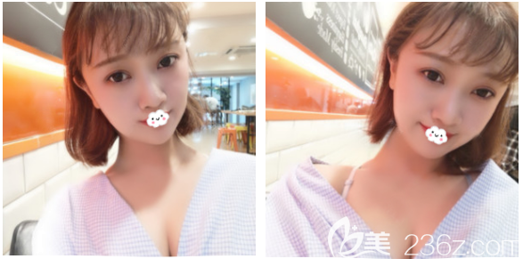 梅州曙光自體脂肪豐胸1個月效果圖