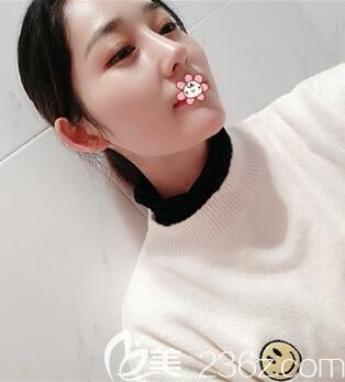 重慶聯(lián)合麗格鼻綜合術(shù)后一個(gè)月 重慶聯(lián)合麗格鼻綜合術(shù)后一個(gè)月