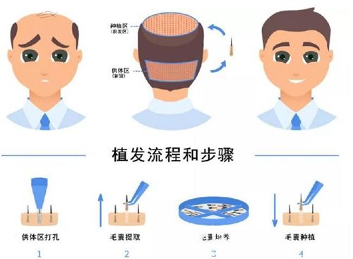 長沙岱高FUE植發(fā)手術(shù)流程