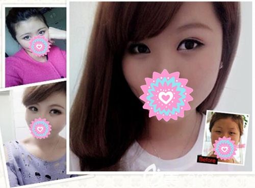 瞇瞇眼通過南陽華美的雙眼皮術(shù)成功變美 瞇瞇眼通過南陽華美的雙眼皮術(shù)成功變美