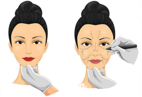 韓國原辰拉皮手術(shù)怎么樣？