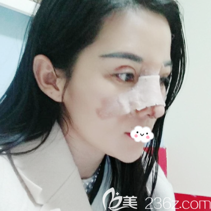 找深圳非凡梅夠明做雙眼皮修復和隆鼻術(shù)后三天