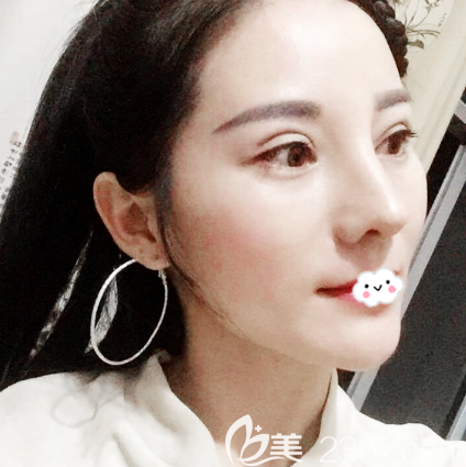 大家只知道深圳非凡梅夠明鼻子做的好卻不知道他的雙眼皮修復技術(shù)也很棒哦