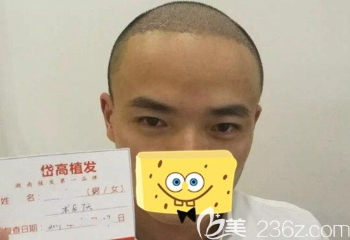 植發(fā)7天，看起來(lái)像是剪了寸頭