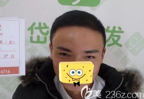 植發(fā)7個(gè)月， 幾乎看不出脫發(fā)的痕跡