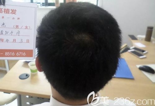 植發(fā)10個(gè)月，后枕部頭發(fā)幾乎沒(méi)有任何改變