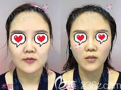 周口締萊美埋線面部提升效果對比