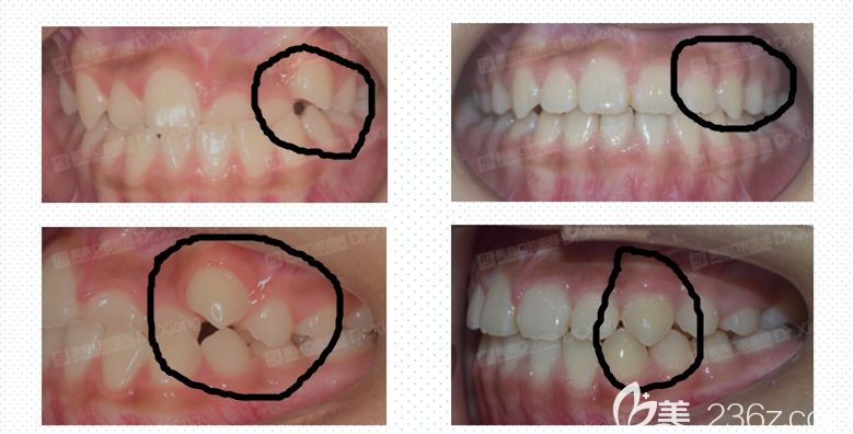 女生虎牙矯正變化圖 女生虎牙矯正變化圖
