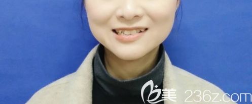 虎牙矯正前圖示 虎牙矯正前圖示