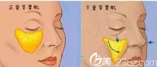 正常蘋果肌和下垂蘋果肌