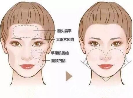 蘋果肌填充術(shù)前術(shù)后對比