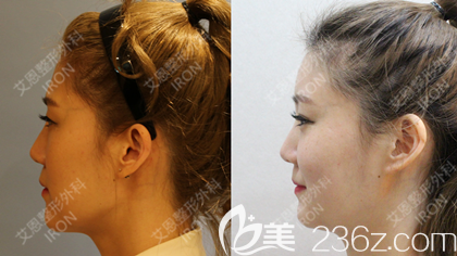 艾恩整形金承俊院長案例