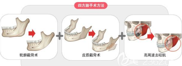 武漢涵美<!--<i data=20240703-sp></i>-->醫(yī)生魔骨去下頜角手術(shù)方法 武漢涵美<!--<i data=20240703-sp></i>-->醫(yī)生魔骨去下頜角手術(shù)方法