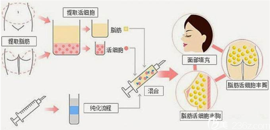 自體脂肪移植填充原理與過程圖解 自體脂肪移植填充原理與過程圖解