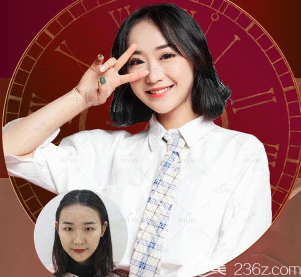 <!--<i data=20240703-sp></i>-->美萊急速納米美眼第7天恢復(fù)效果對比圖