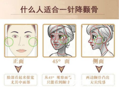 適合做一針降顴骨的人群 適合做一針降顴骨的人群