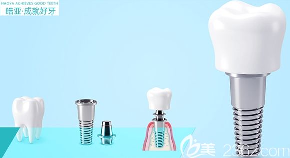 蘭州皓亞齒科種植牙成就好牙 蘭州皓亞齒科種植牙成就好牙