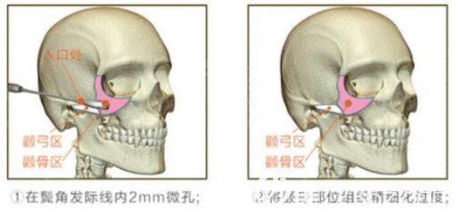 一針降顴骨原理 一針降顴骨原理