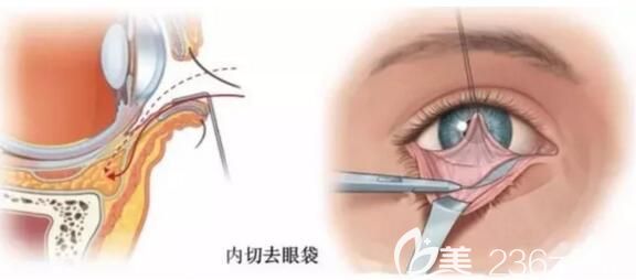 內(nèi)切祛眼袋的位置