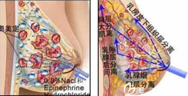 胸部奧美定要取出嗎