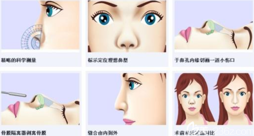 隆鼻手術過程及效果模擬圖