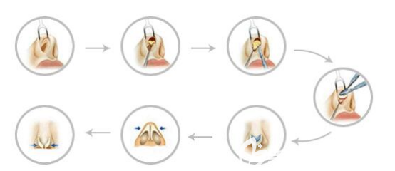 做完鼻綜合手術(shù)定期去復(fù)診非常重要不能單方面覺得鼻子沒有問題就不去
