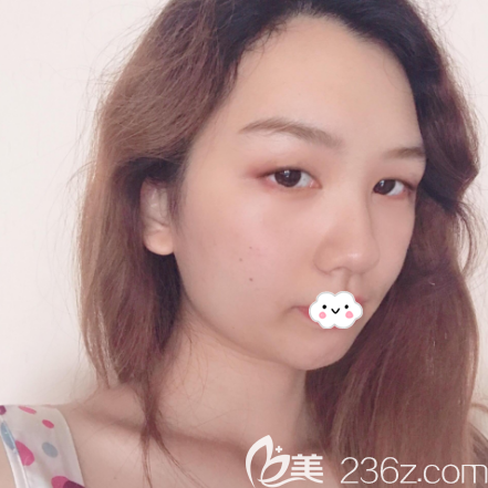 在廣州荔醫(yī)整形醫(yī)院做雙眼皮術(shù)前照片 在廣州荔醫(yī)整形醫(yī)院做雙眼皮術(shù)前照片