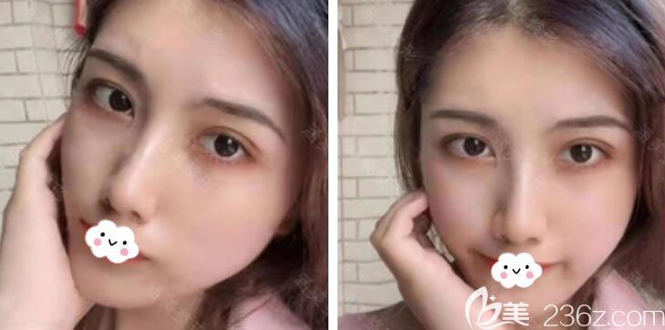 給你們秀一波我在武漢涵美割雙眼皮術(shù)后15天的照片變化