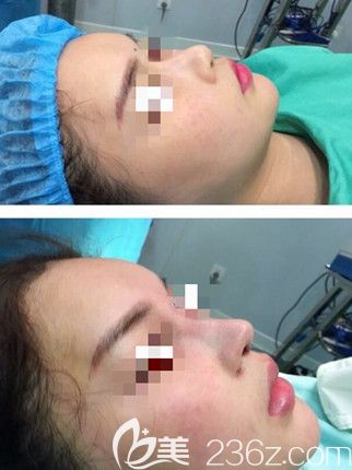 信陽東方人鼻綜合術后效果 信陽東方人鼻綜合術后效果