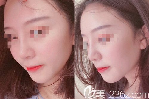 在信陽東方藝做鼻綜合手術(shù)四個(gè)月再也不用擔(dān)心被人說鼻子很假