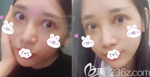 雙眼皮過寬修復(fù)術(shù)后5-7天恢復(fù)圖