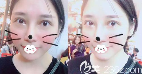 孝感天妃雙眼皮失敗修復(fù)怎么樣？真人案例供參考