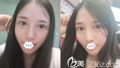 真心感慨整形千萬不要圖價格便宜，多虧找孝感天妃做高難度眼修復(fù)成功了！