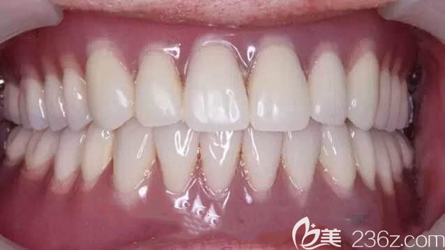 做完locator種植覆蓋義齒修復(fù)圖示 做完locator種植覆蓋義齒修復(fù)圖示