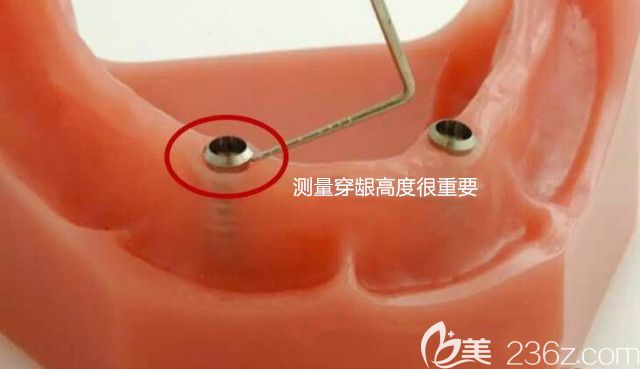 測(cè)量穿齦高度圖示 測(cè)量穿齦高度圖示