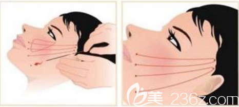 做完埋線提升后線會(huì)斷的原因可能是咀嚼太硬的食物或者做夸張的表情了