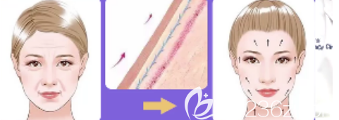 做完埋線提升后線會(huì)斷的原因可能是咀嚼太硬的食物或者做夸張的表情了