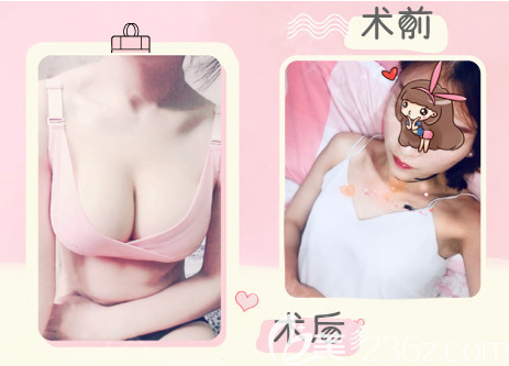 隆胸假體取出的同時(shí)做脂肪豐胸的圖