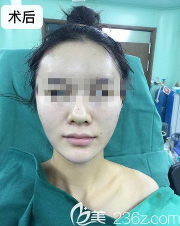 這有一波我剛做完全臉脂肪填充手術當天凹陷的臉頰變圓潤的對比照片