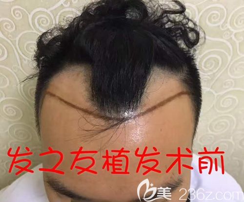 看我兩側(cè)額角的頭發(fā)在不斷脫落 看我兩側(cè)額角的頭發(fā)在不斷脫落