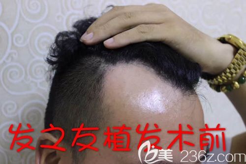 在植發(fā)前試了很多防脫方法都沒效果 在植發(fā)前試了很多防脫方法都沒效果