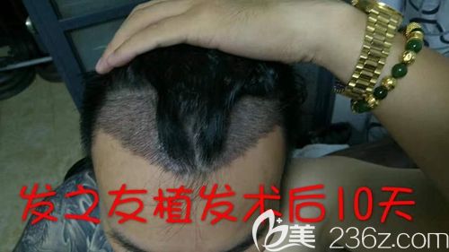 我前額雄性脫發(fā)有幸通過FD-FUE植發(fā)技術(shù)躲過了“中年危機”